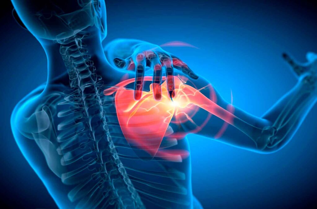 Tendinitis del manguito rotador