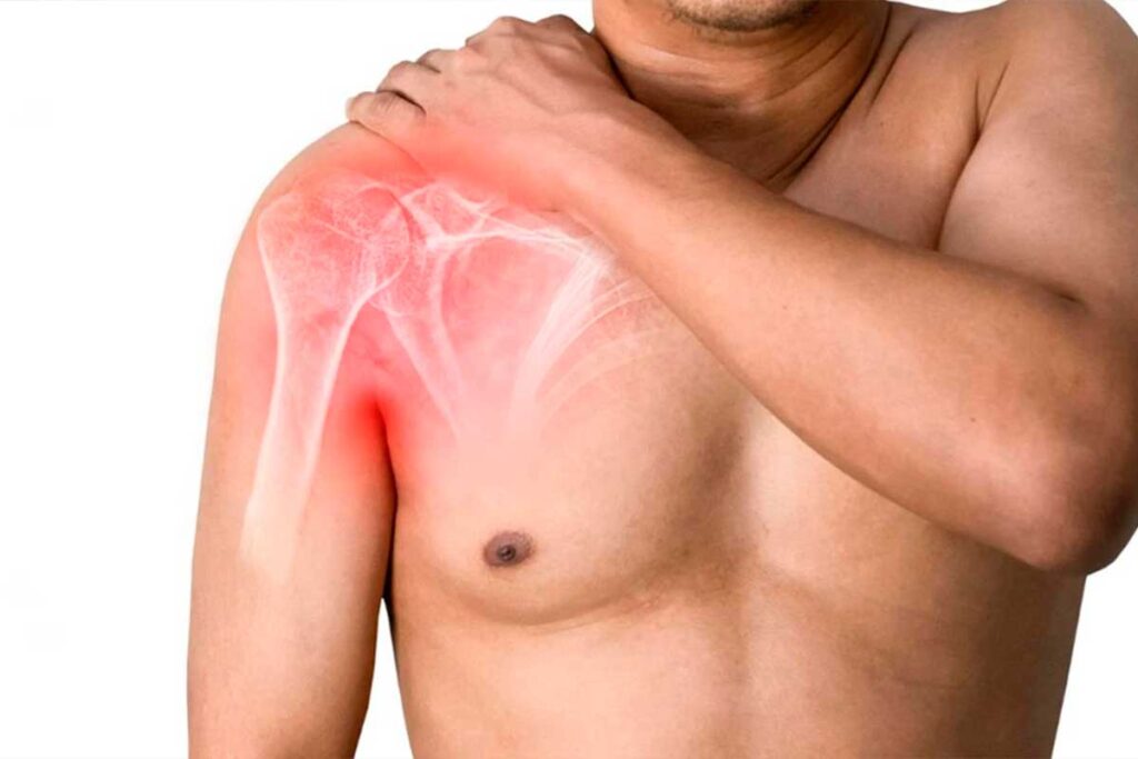 Qué es bursitis de hombro